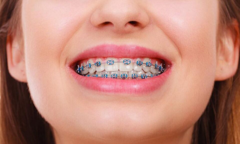 What You Should Know About Lingual Braces