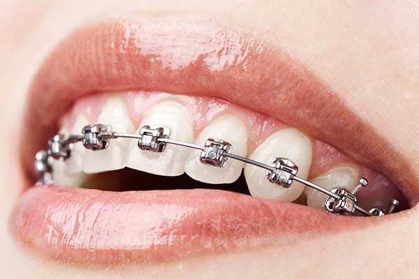 Lingual Braces